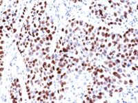 FFPE human lung squamous cell carcinoma (scc) sections stained with 100 ul anti-p21WAF1 (clone CIP1/823) at 1:50. HIER epitope retrieval prior to staining was performed in 10mM Citrate, pH 6.0.